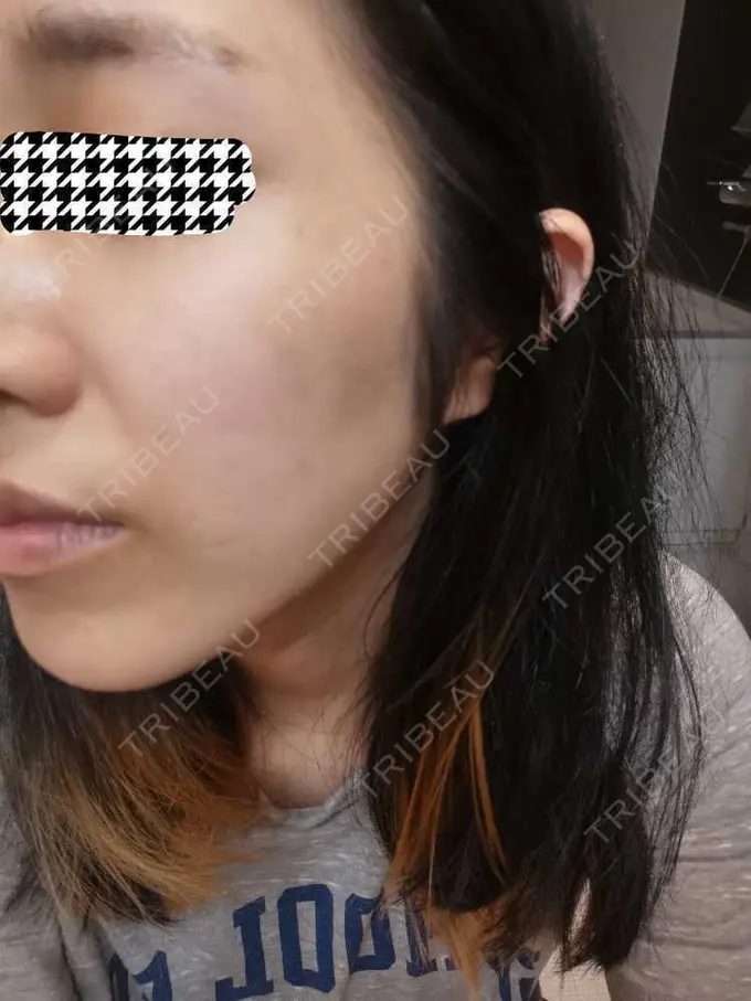 ルメッカ ルラ美容クリニック 高田馬場院 AFTER メイン用