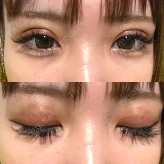 二重埋没 日本ウェルネス再生クリニック DAY 7 メイン用