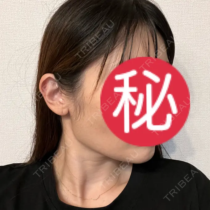 ボトックス（エラ・小顔） Code Beauty Clinic 名古屋院 DAY 1 メイン用