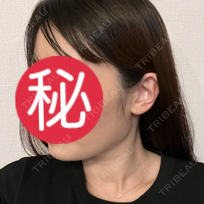 ボトックス（エラ・小顔） Code Beauty Clinic 名古屋院 DAY 1 メイン用