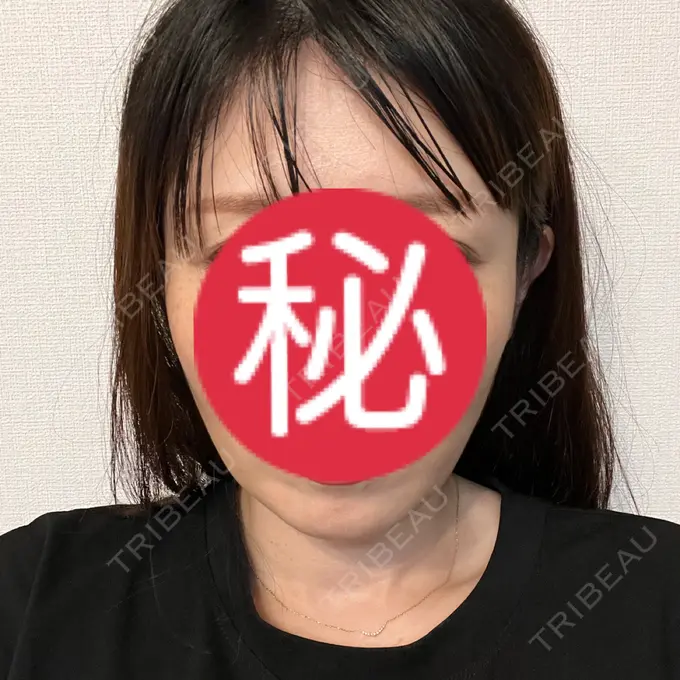 ボトックス（エラ・小顔） Code Beauty Clinic 名古屋院 DAY 1 メイン用