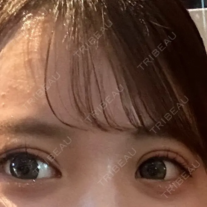 二重埋没 アリエル美容クリニック 郡山院 DAY 4 メイン用