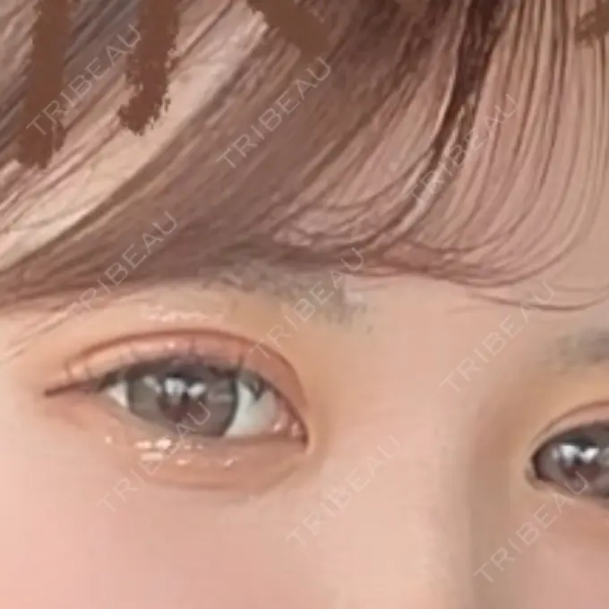 二重埋没 アリエル美容クリニック 郡山院 DAY 5 メイン用