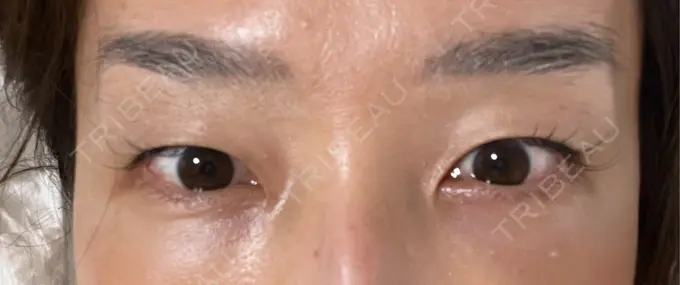 クマ治療 セオリークリニック DAY 8 メイン用