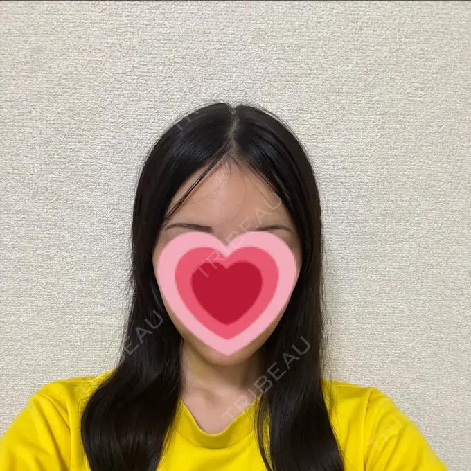 糸リフト / 脂肪吸引（顔） / ボトックス（エラ・小顔） RIVER CLINIC（リバークリニック） DAY 8 メイン用