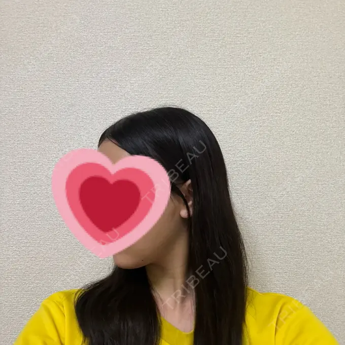 糸リフト / 脂肪吸引（顔） / ボトックス（エラ・小顔） RIVER CLINIC（リバークリニック） DAY 8 メイン用