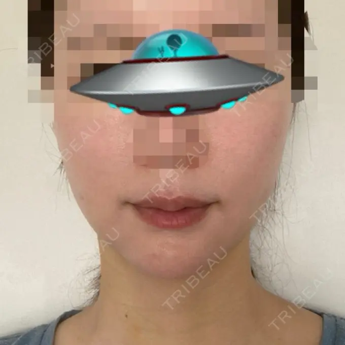 糸リフト / 骨切り（あご） / 脂肪吸引注射（顔） 銀座マイアミ美容外科 DAY 11 メイン用