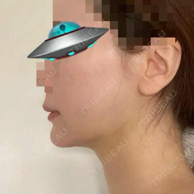 糸リフト / 骨切り（あご） / 脂肪吸引注射（顔） 銀座マイアミ美容外科 DAY 11 メイン用