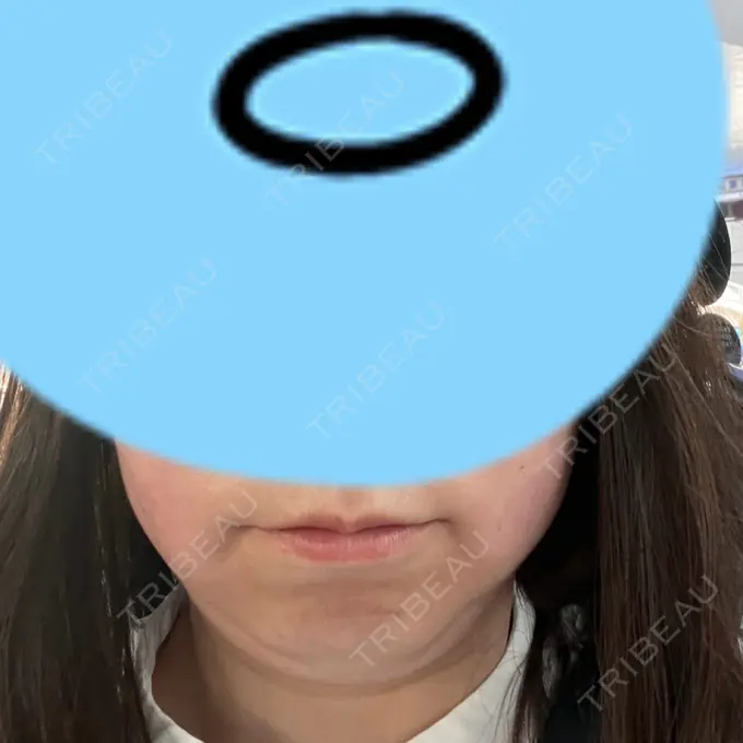 脂肪溶解注射（顔） 表参道ウィズ・クリニック DAY 0 メイン用