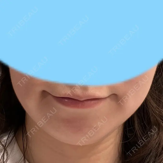 脂肪溶解注射（顔） 表参道ウィズ・クリニック DAY 1 メイン用