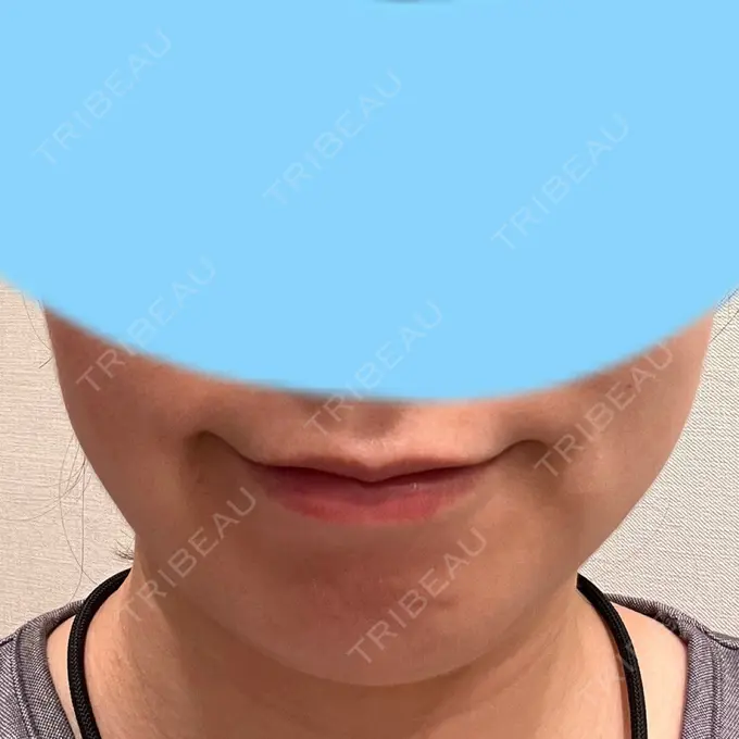 脂肪溶解注射（顔） 表参道ウィズ・クリニック DAY 2 メイン用