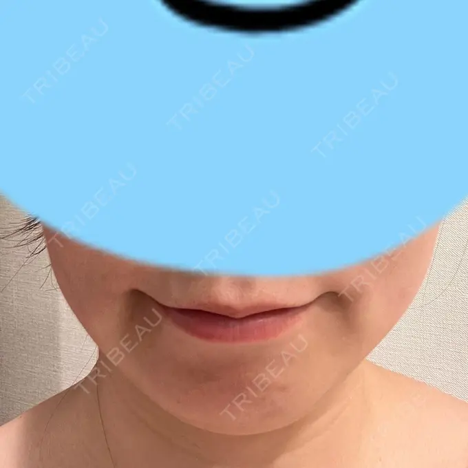 脂肪溶解注射（顔） 表参道ウィズ・クリニック DAY 4 メイン用