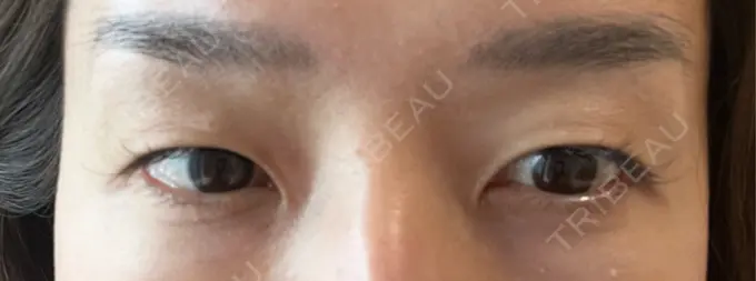 クマ治療 セオリークリニック DAY 9 メイン用