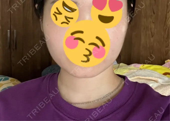 脂肪吸引（顔） Mods Clinic（モッズクリニック） 名古屋院 DAY 79 メイン用