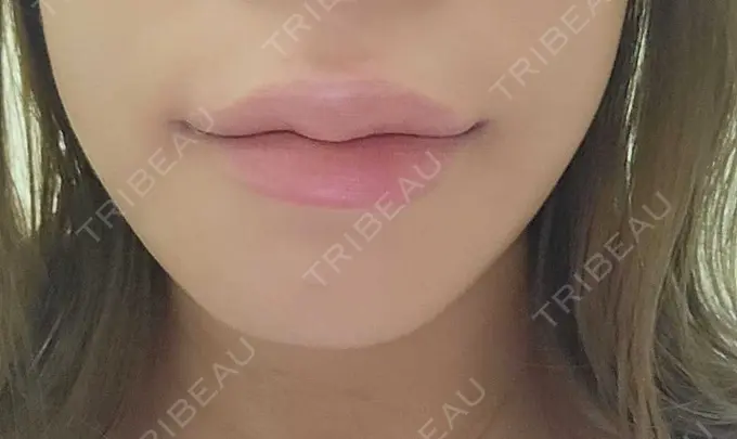 ヒアルロン酸注入（唇） / ボトックス（口角） ルラ美容クリニック 神戸院 AFTER メイン用