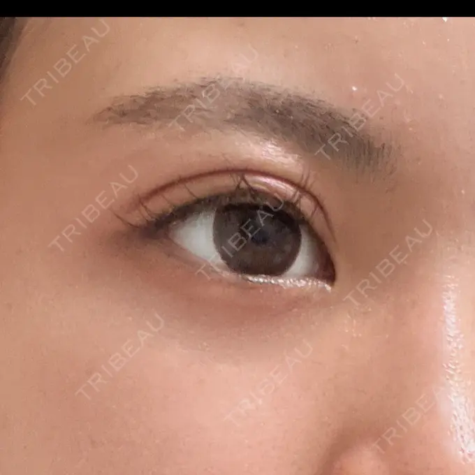 二重埋没 アリエル美容クリニック 郡山院 DAY 6 メイン用