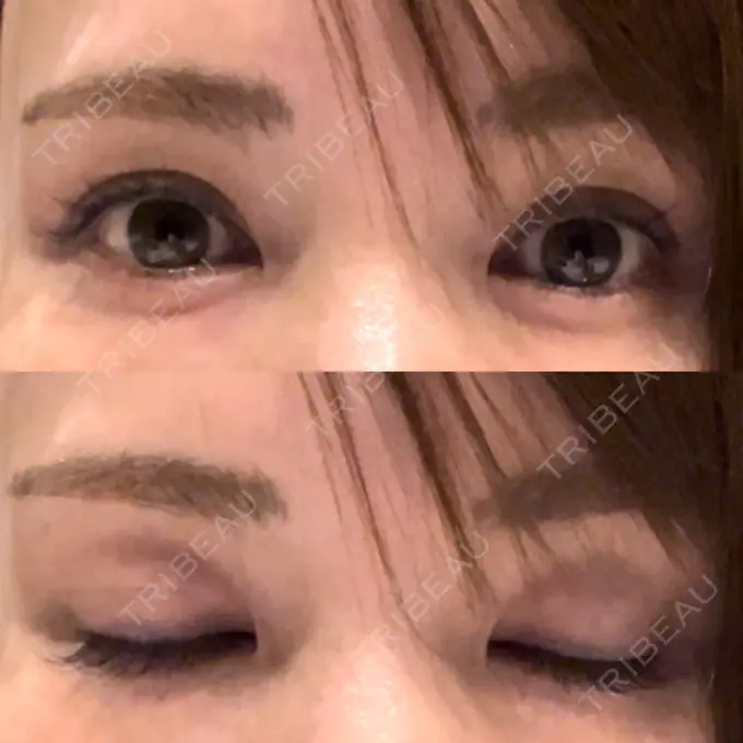 二重埋没 吉祥寺アイビークリニック DAY 2 メイン用