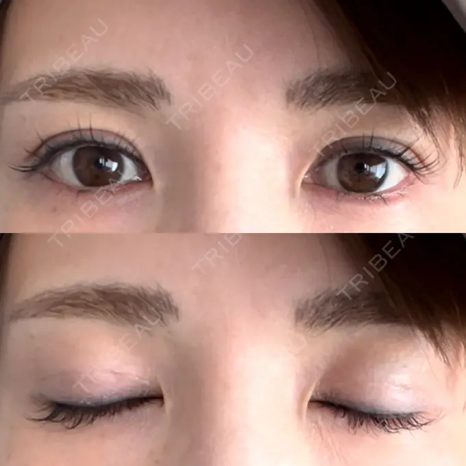 二重埋没 吉祥寺アイビークリニック DAY 3 メイン用