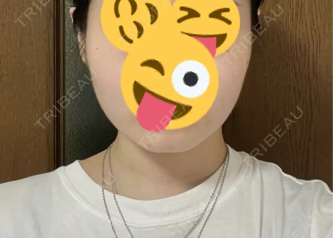 脂肪吸引（顔） Mods Clinic（モッズクリニック） 名古屋院 DAY 80 メイン用