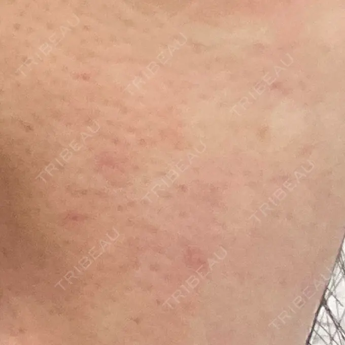 マイクロボトックス / その他（肌） Zetith Beauty Clinic 福岡院 AFTER メイン用