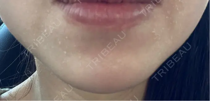 ボトックス（あご） ルラ美容クリニック 名古屋本院 DAY 10 メイン用