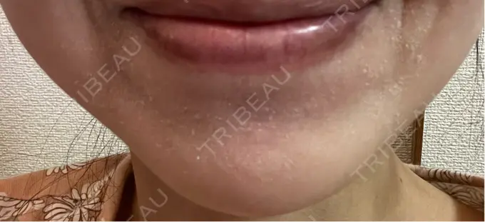 ボトックス（あご） ルラ美容クリニック 名古屋本院 AFTER メイン用