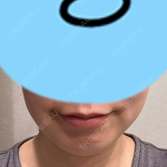 脂肪溶解注射（顔） 表参道ウィズ・クリニック DAY 9 メイン用