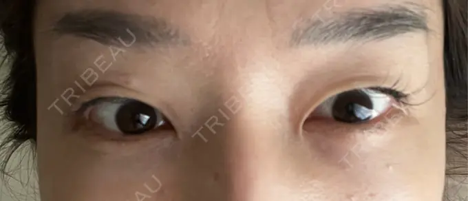 クマ治療 セオリークリニック AFTER メイン用