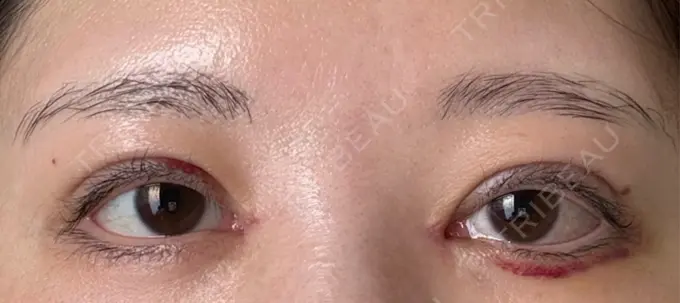 二重埋没 / 目頭切開 / クマ治療 ROOTS Clinic DAY 9 メイン用