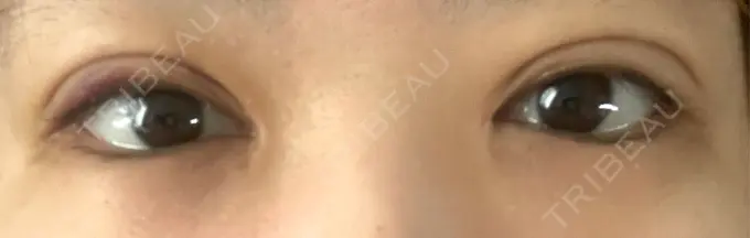 二重埋没 東京シンデレラ美容外科 大宮院 DAY 7 メイン用