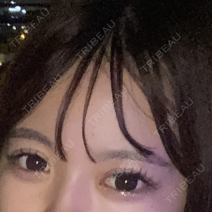 二重埋没 アリエル美容クリニック 郡山院 DAY 7 メイン用