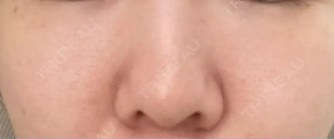 ピーリング（ニキビ・毛穴） / エレクトロポレーション / レーザートーニング（美白・肝斑） 湘南美容クリニック 川崎院 DAY 33 メイン用