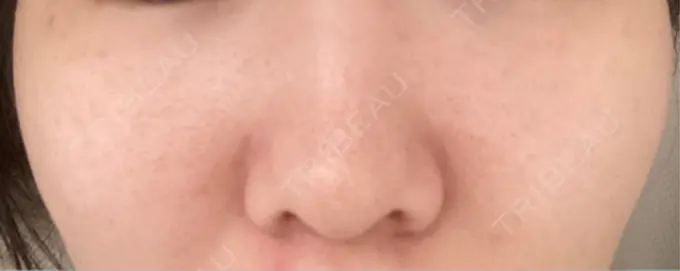 ピーリング（ニキビ・毛穴） / エレクトロポレーション / レーザートーニング（美白・肝斑） 湘南美容クリニック 川崎院 DAY 4 メイン用