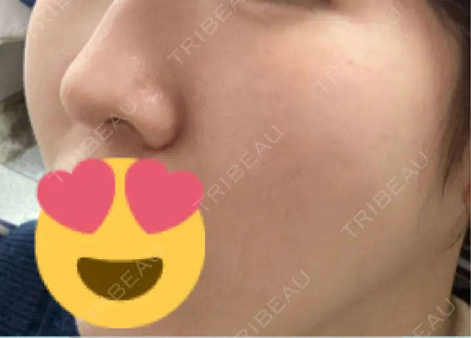 ピーリング（ニキビ・毛穴） / エレクトロポレーション / レーザートーニング（美白・肝斑） 湘南美容クリニック 川崎院 DAY 6 メイン用