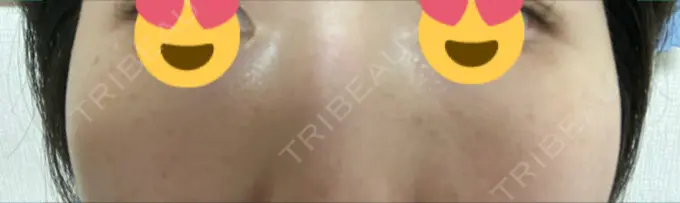 ピーリング（ニキビ・毛穴） / エレクトロポレーション / レーザートーニング（美白・肝斑） 湘南美容クリニック 川崎院 DAY 8 メイン用