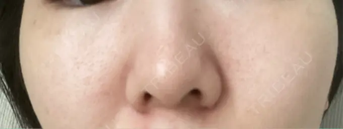 ピーリング（ニキビ・毛穴） / エレクトロポレーション / レーザートーニング（美白・肝斑） 湘南美容クリニック 川崎院 DAY 19 メイン用