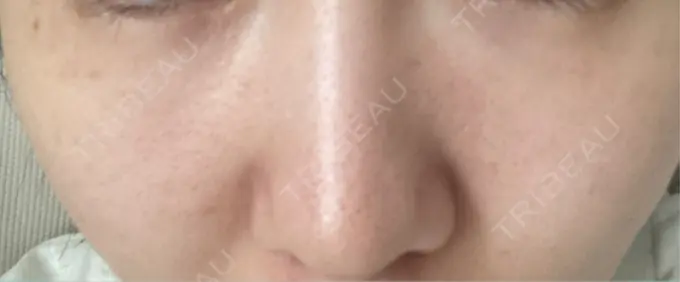 ピーリング（ニキビ・毛穴） / エレクトロポレーション / レーザートーニング（美白・肝斑） 湘南美容クリニック 川崎院 DAY 17 メイン用