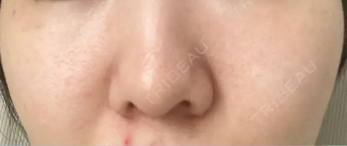 ピーリング（ニキビ・毛穴） / エレクトロポレーション / レーザートーニング（美白・肝斑） 湘南美容クリニック 川崎院 DAY 22 メイン用