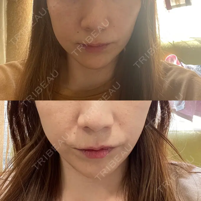 糸リフト / 脂肪吸引（顔） / ボトックス（エラ・小顔） RIVER CLINIC（リバークリニック） AFTER メイン用