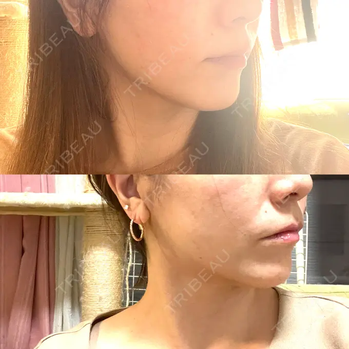 糸リフト / 脂肪吸引（顔） / ボトックス（エラ・小顔） RIVER CLINIC（リバークリニック） DAY 29 メイン用