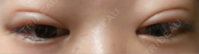 二重埋没 / 上まぶたの脂肪取り アリエル美容クリニック 郡山院 DAY 16 メイン用