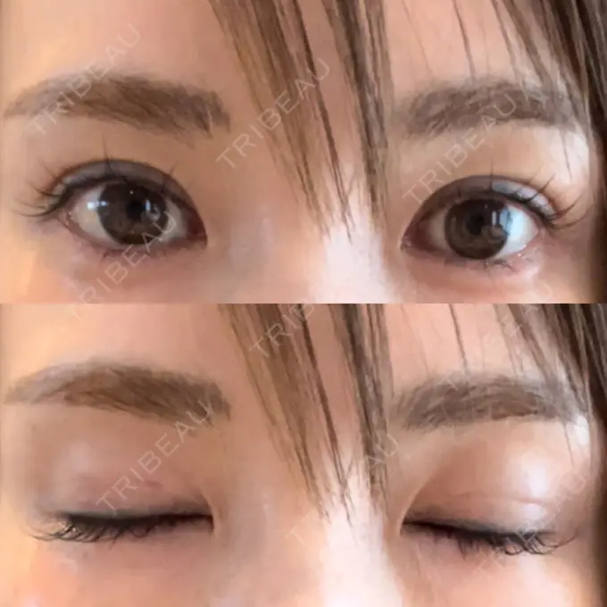 二重埋没 吉祥寺アイビークリニック DAY 4 メイン用