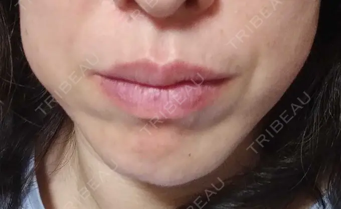 ボトックス（エラ・小顔） TCB東京中央美容外科 金山院 DAY 25 メイン用