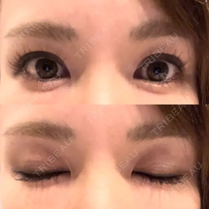 二重埋没 吉祥寺アイビークリニック DAY 5 メイン用