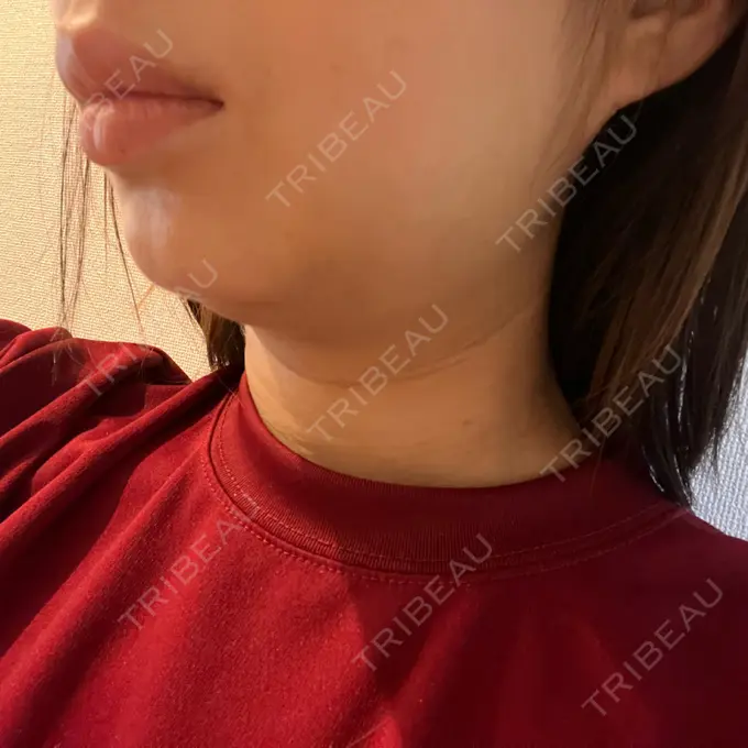 脂肪吸引（顔） / スネコス PRISM Beauty Clinic 町田院 DAY 2 メイン用