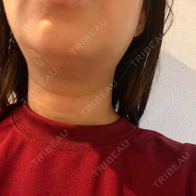 脂肪吸引（顔） / スネコス PRISM Beauty Clinic 町田院 DAY 2 メイン用