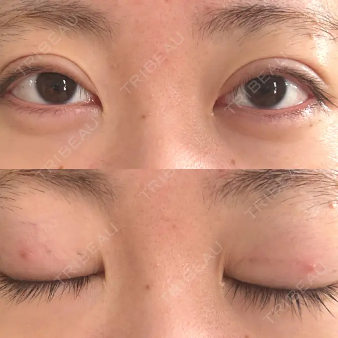 二重埋没 東京ココセランクリニック DAY 24 メイン用