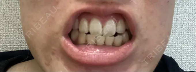 ホワイトニング 池袋駅前デンタルクリニック AFTER メイン用