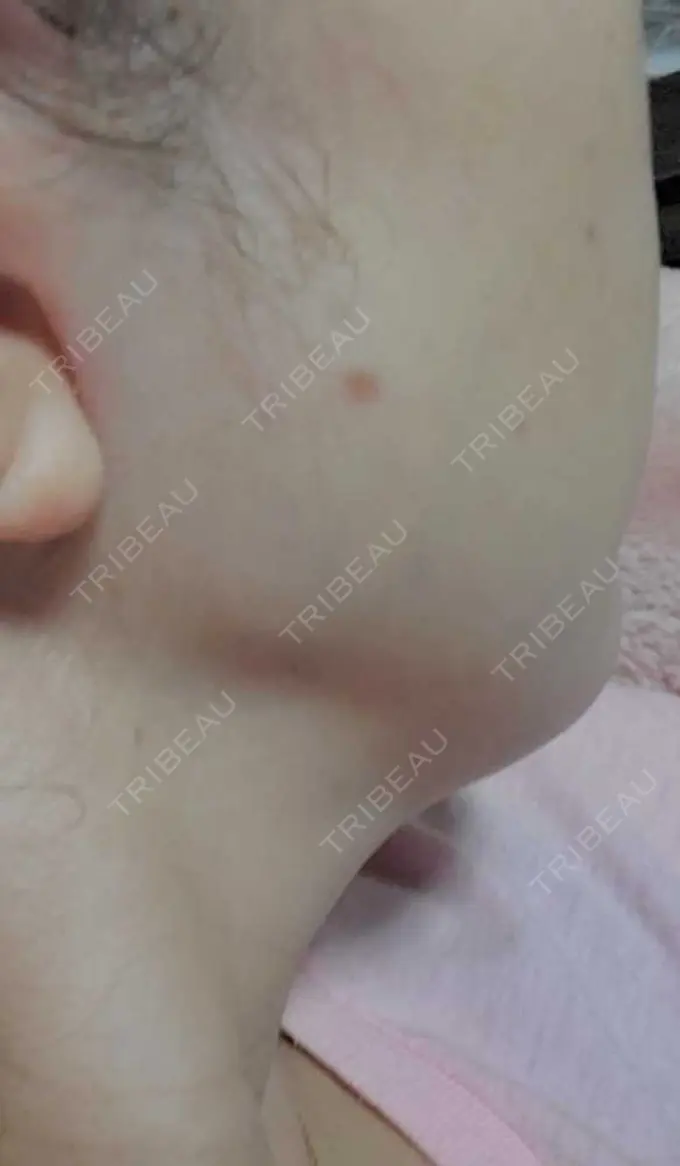 ほくろ・いぼ除去レーザー（肌） Mavie Beauty Clinic （マヴィービューティークリニック） DAY 71 メイン用