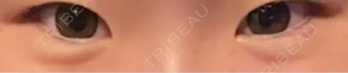 ヒアルロン酸注入（涙袋） 共立美容外科 浜松院 AFTER メイン用